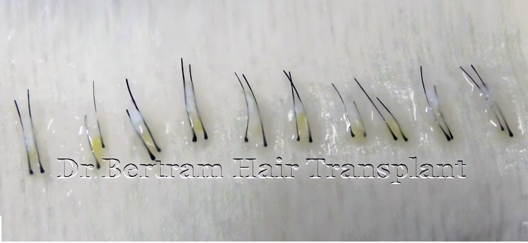 follicular units