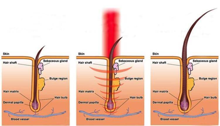 Laser hair therapy - a non-medical hair loss treatment