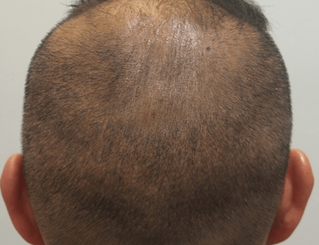Dr Bertram High Density FUE hair transplant technique