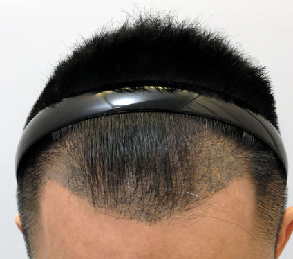 Disadvantage of SMP in repairing hair loss