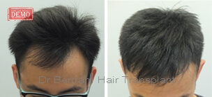 hair transplant before and after picture men