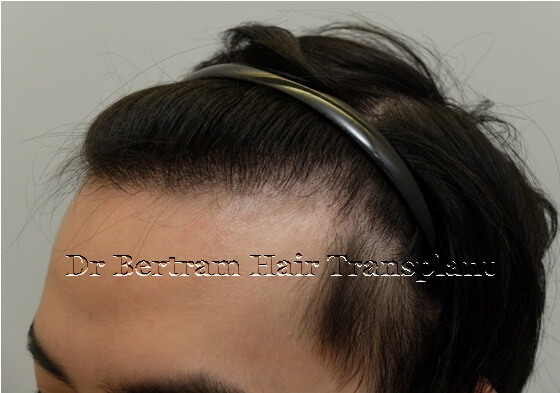 hair transplant before and after photo