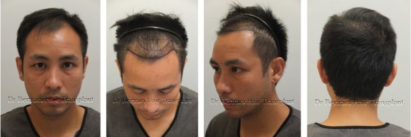 What to Expect the next 12 months Dr Bertram Hair Transplant
