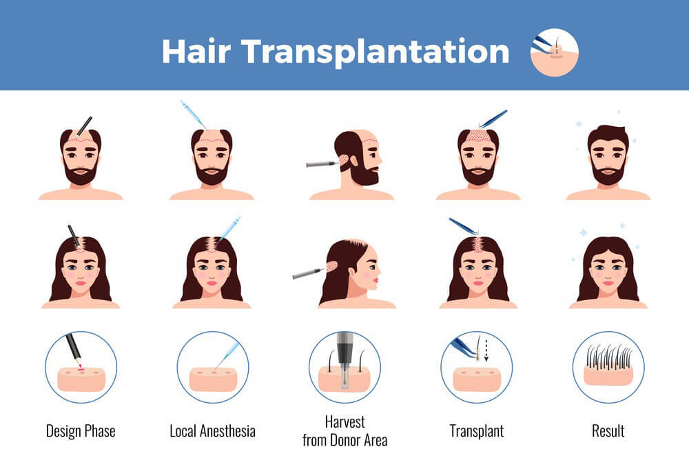 Hair Transplant Surgery Procedure Overview