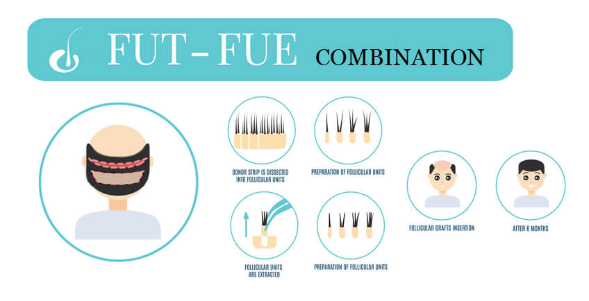FUE extraction diagram