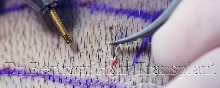 Advanced FUE utilizes precision instrumentation