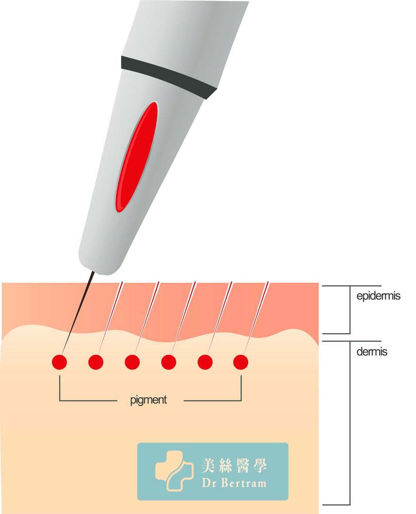 Microscopic view of pigment placement