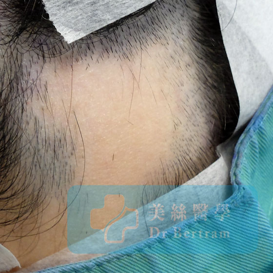 SMP for alopecia areata
