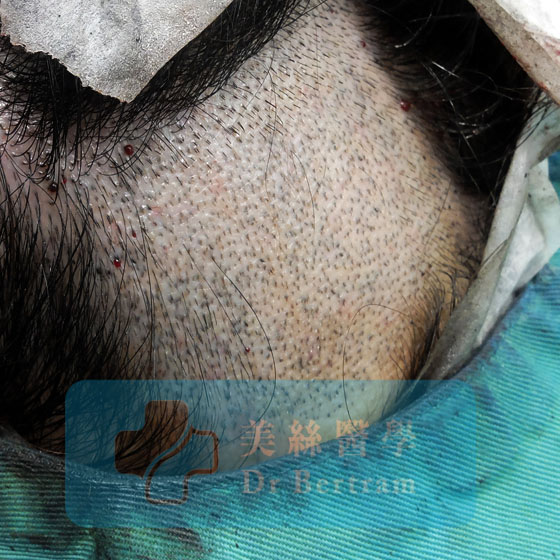 Patient donor area 12 months after surgery