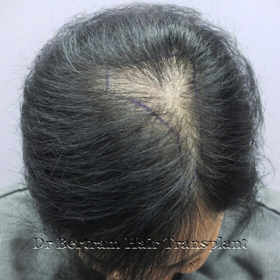 SMP for diffuse thinning