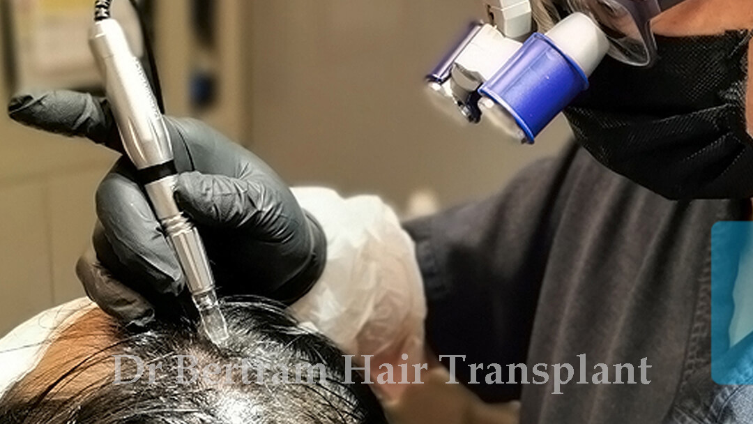 Scalp Micropigmentation technique