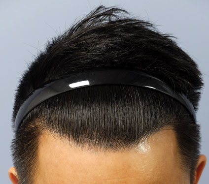 After hair transplant correction