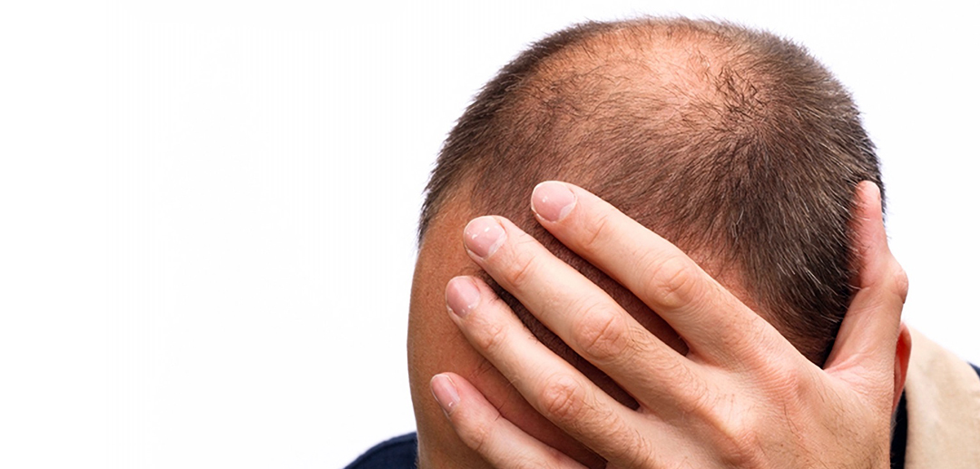 The Psychosocial Impact of Male Hair Loss