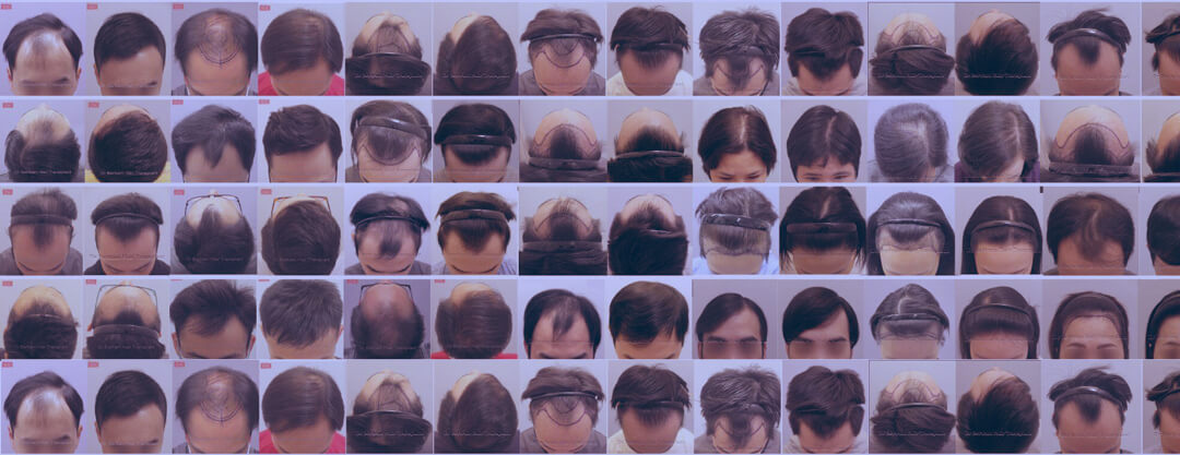 Clinical gallery of female hair restoration results