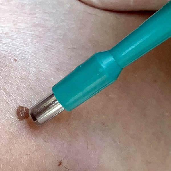 4mm plug graft