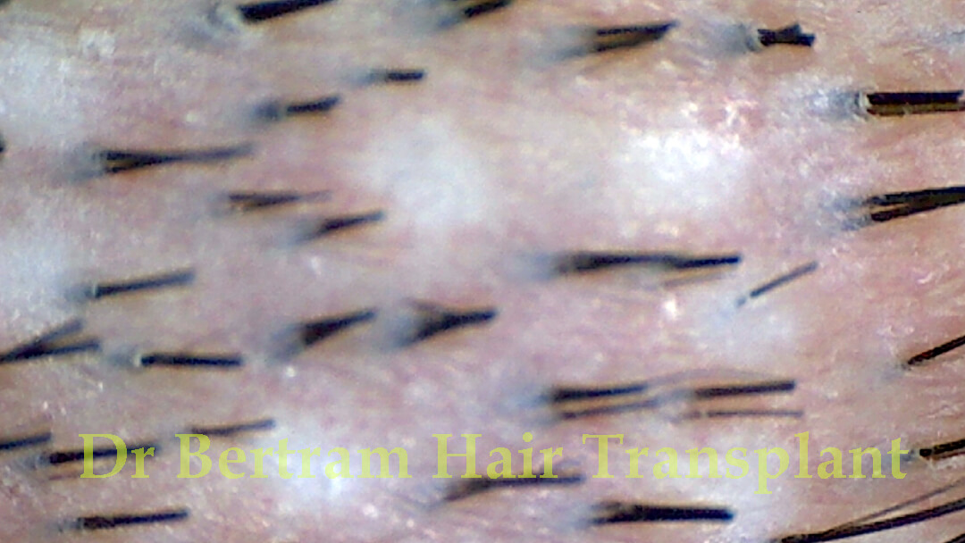 Example of patchy donor area due to over-harvesting