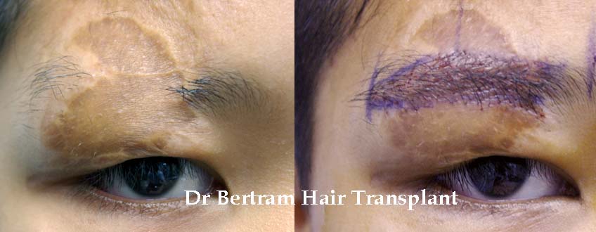 Scar repair clinical result