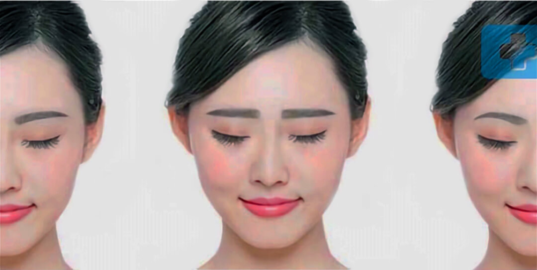 Eyebrow transplant candidacy assessment