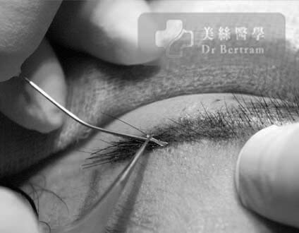 Forceps holding hair shaft tip