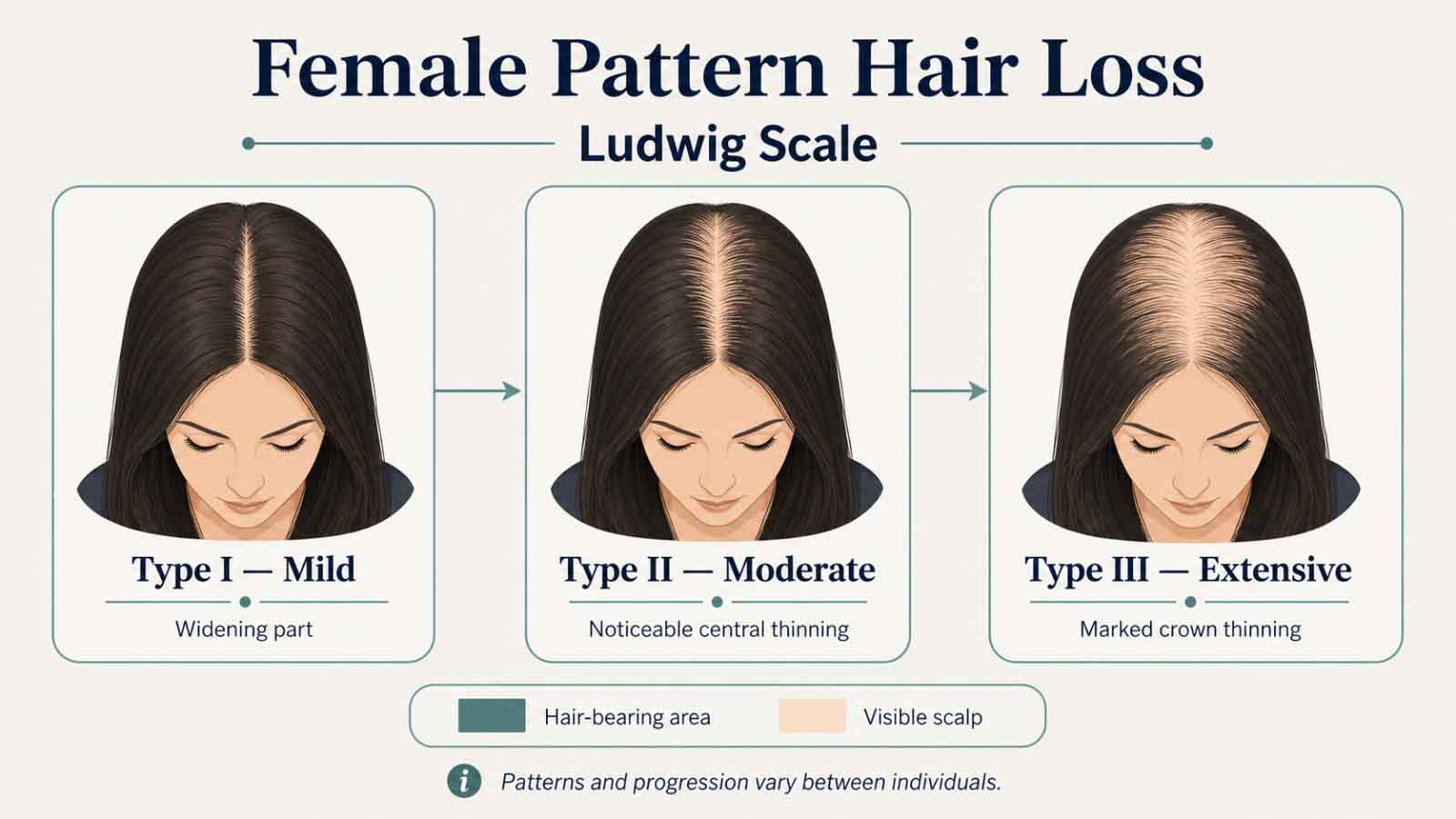 Illustration of female hair loss patterns and follicular structure
