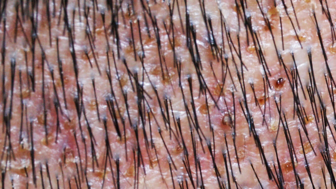 Folliculitis with yellow crusts