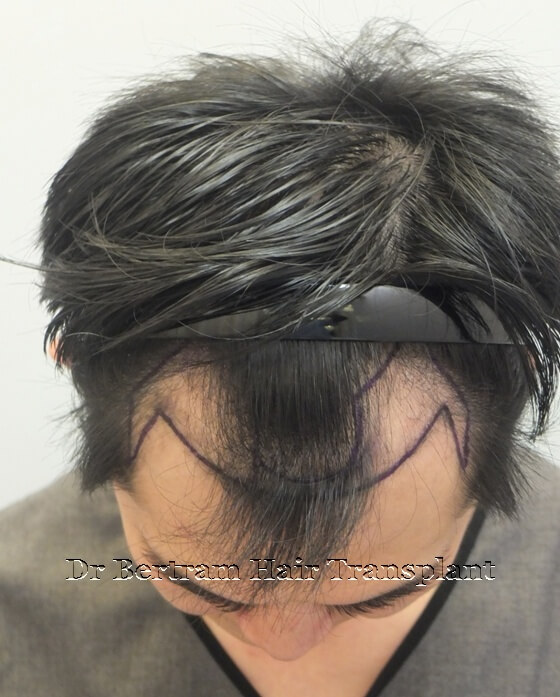 Before: Frontal view, Class III pattern