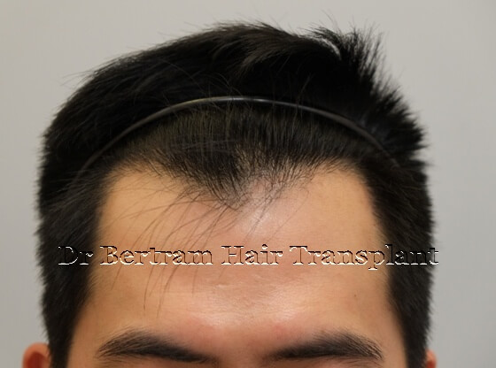 12 months post-procedure: Left side view