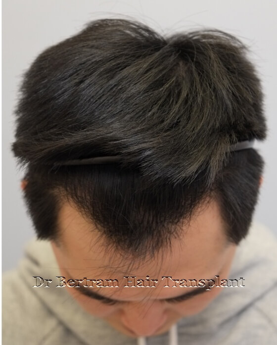 12 months post-procedure: Frontal view