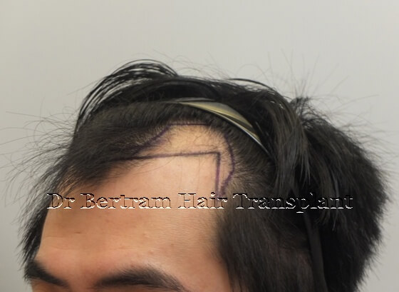 Before: Right side view