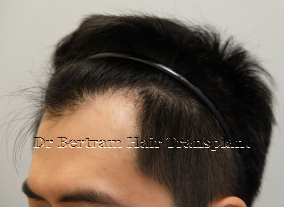 12 months post-procedure: Right side view