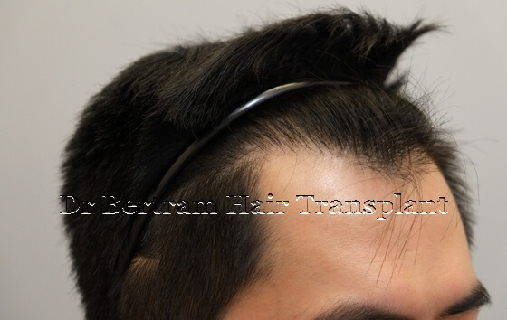 12 months post-procedure: Additional view