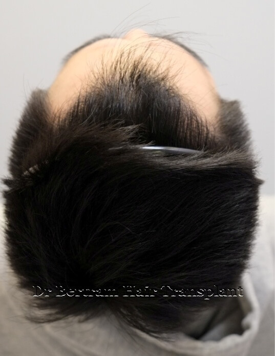 12 months post-procedure: Top view
