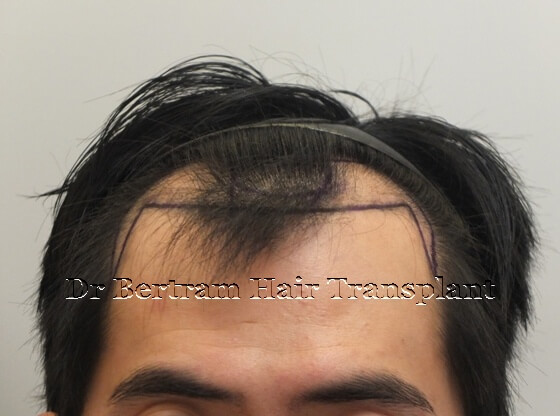 Before: Left side view