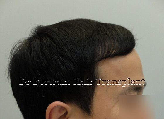 12 months post-procedure: Right side view