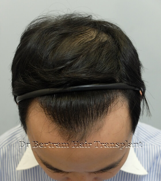 12 months post-procedure: Close-up view