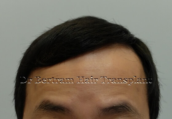 12 months post-procedure: Top view