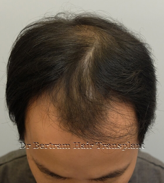 Before: Frontal view, Class IVa pattern