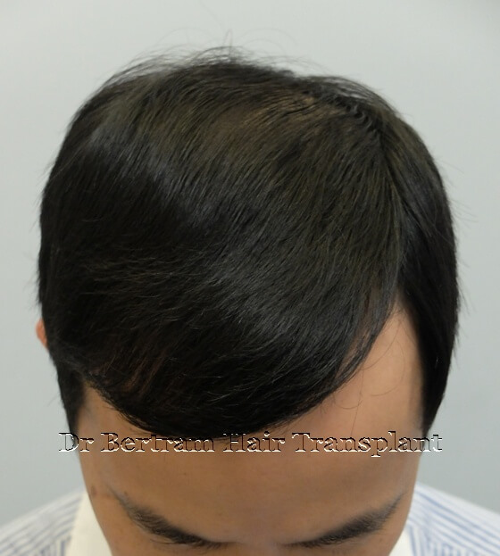12 months post-procedure: Frontal view