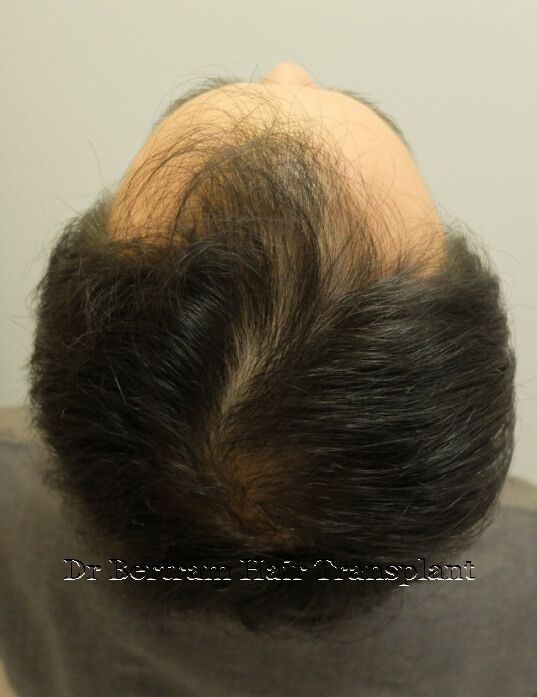 Before: Left oblique view