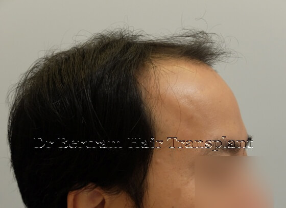 Before: Right side view
