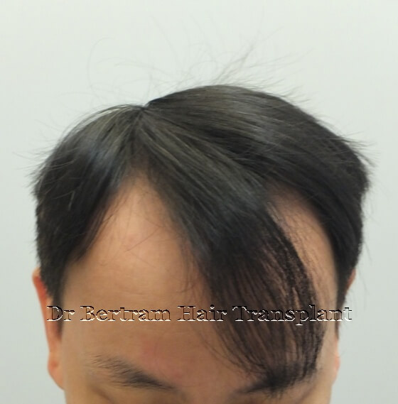 Before: Frontal view, Class IV pattern