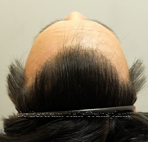 12 months post-procedure: Close-up view