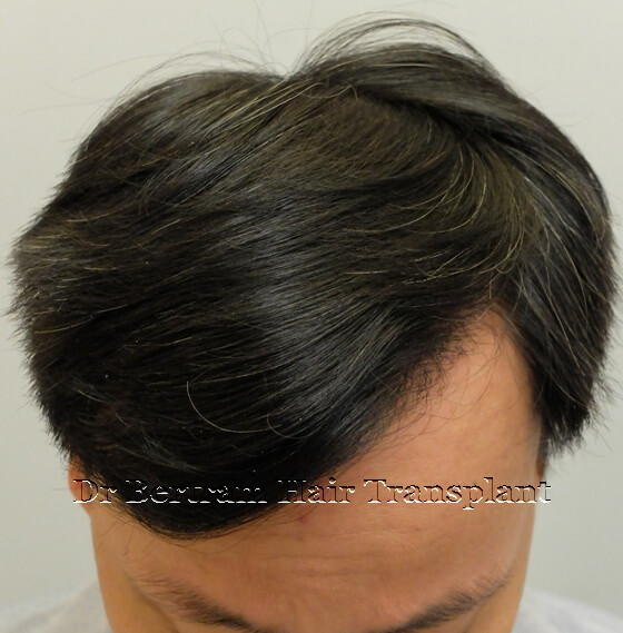12 months post-procedure: Frontal view