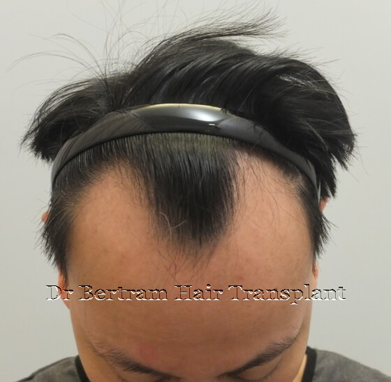 Before: Left side view