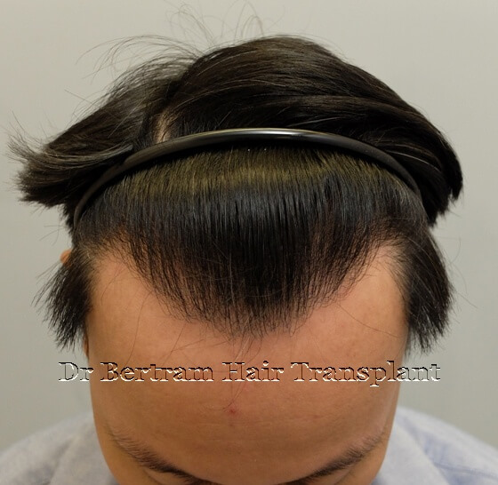 12 months post-procedure: Left side view