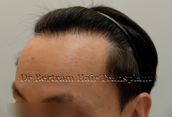 12 months post-procedure: Top view