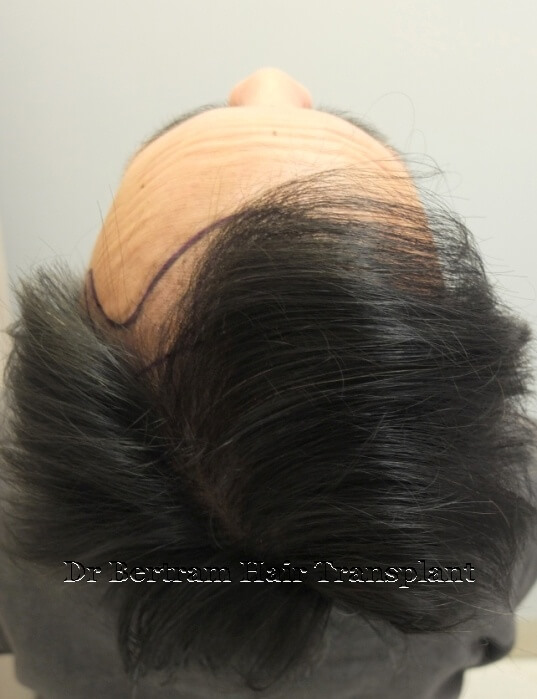 Before: Right side view