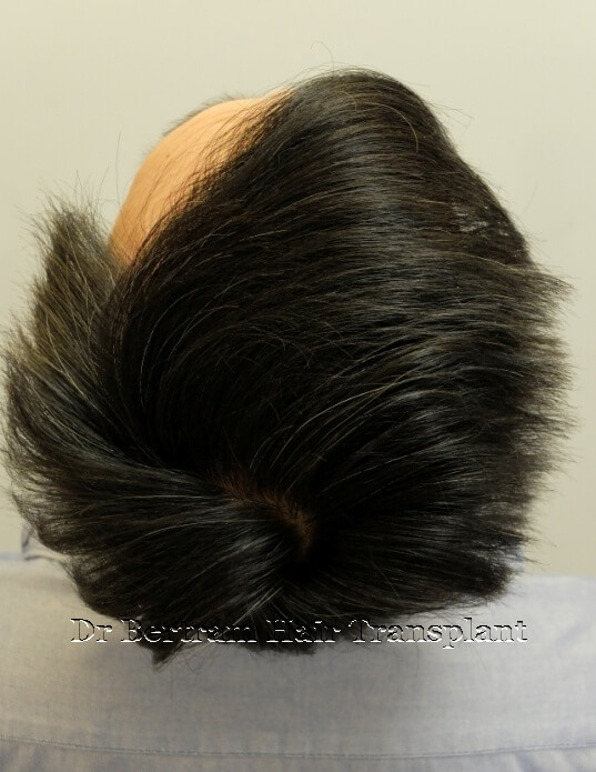 12 months post-procedure: Right side view