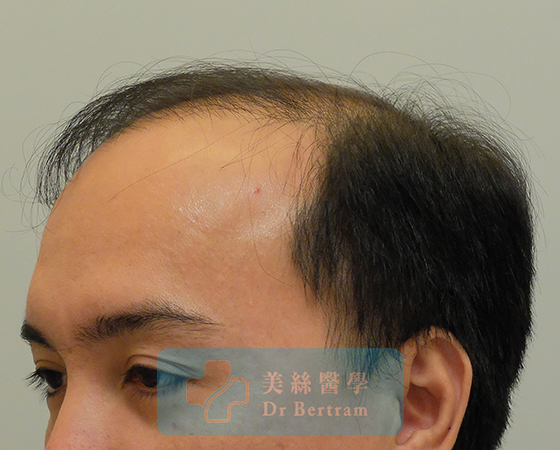 Pre-procedure