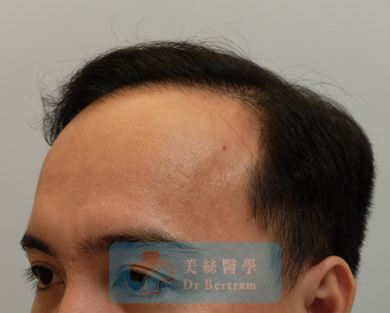 12 months post-procedure